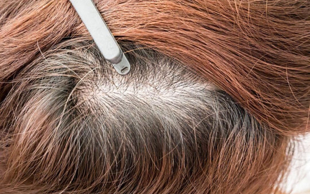 PCOS and hair loss