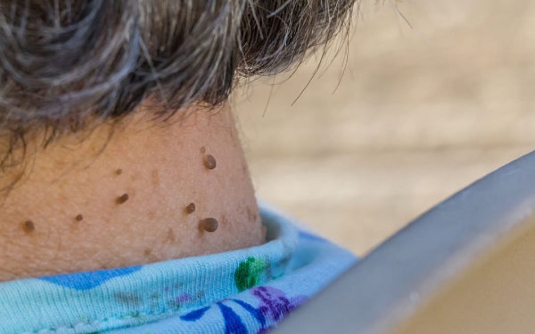 Skin tags – your early warning sign of insulin resistance